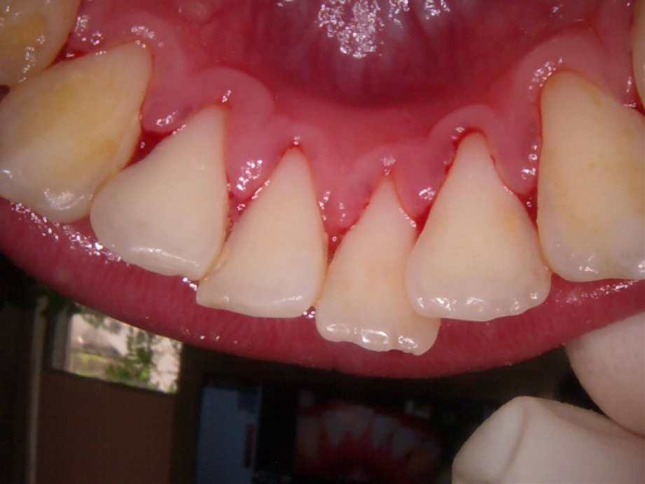 治療後（下顎）