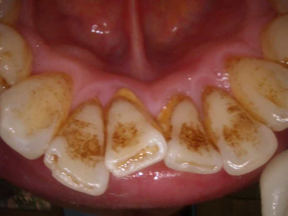 治療前（下顎）