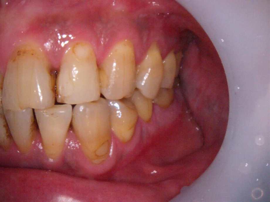 治療前（左側面）