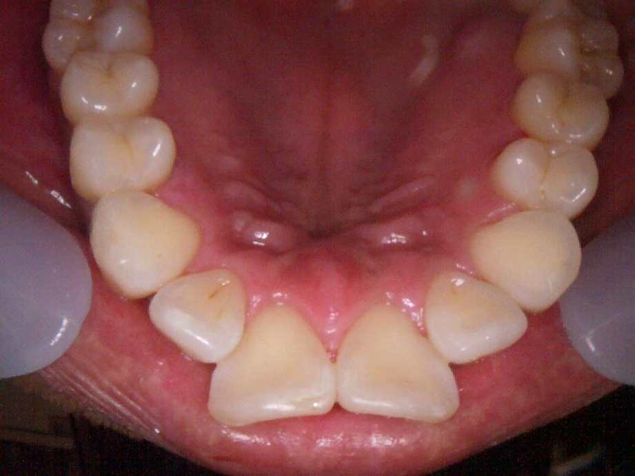 治療後（上顎）