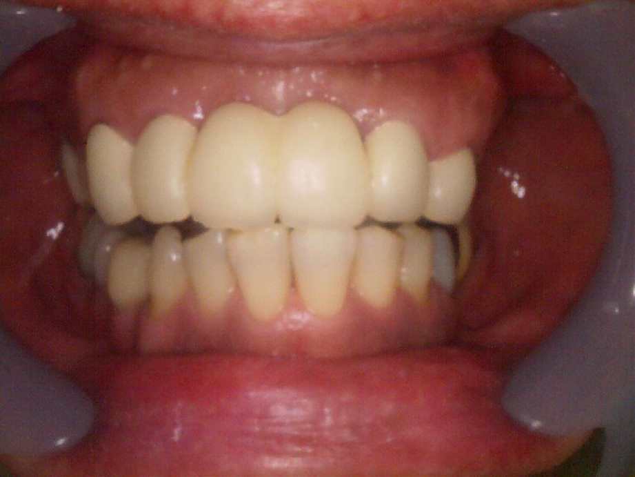 治療後（正面）