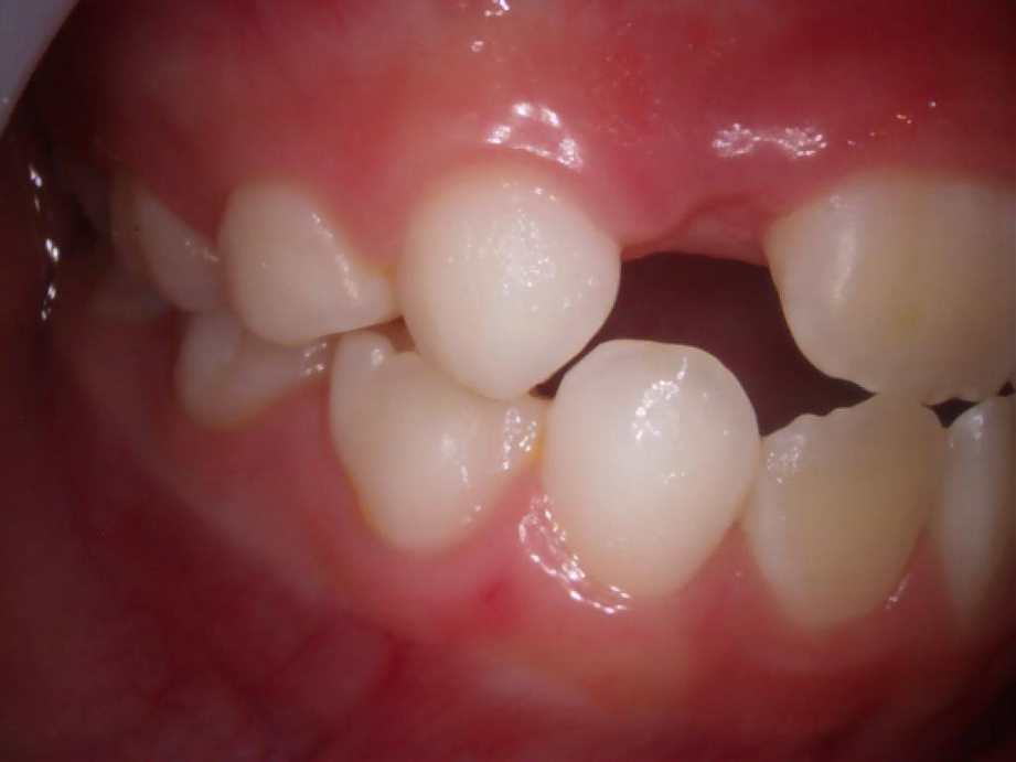 治療前（右側面）