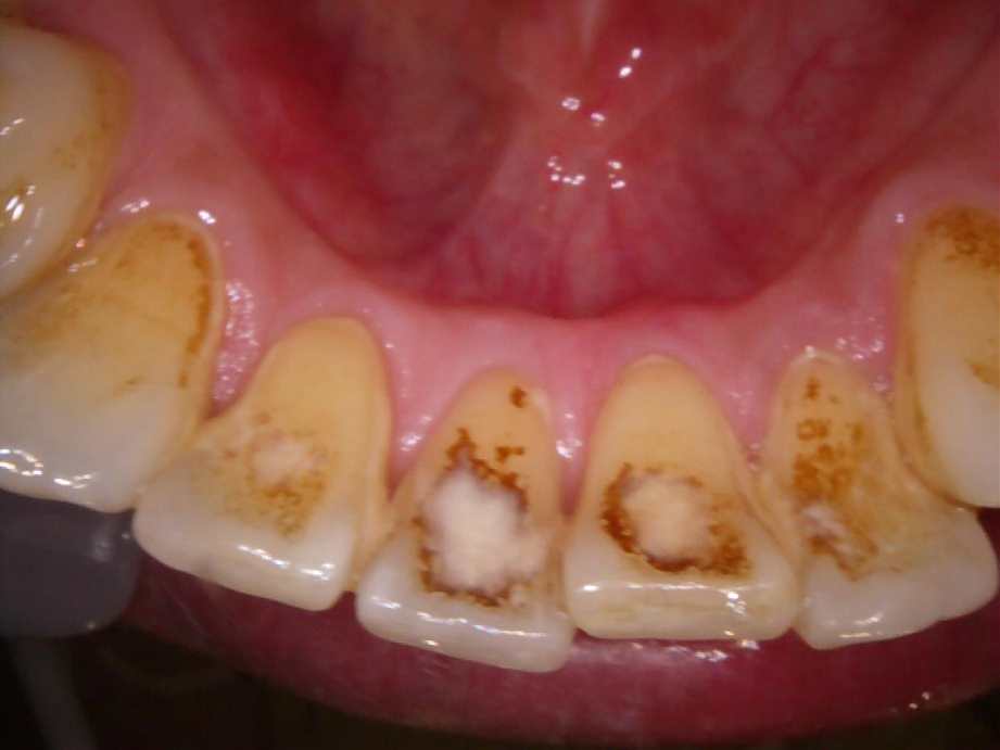 治療前（下顎）