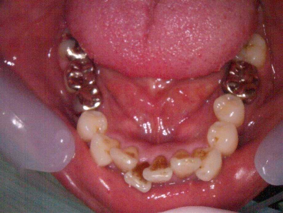 治療前（下顎）