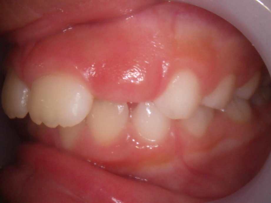 治療前（左側面）