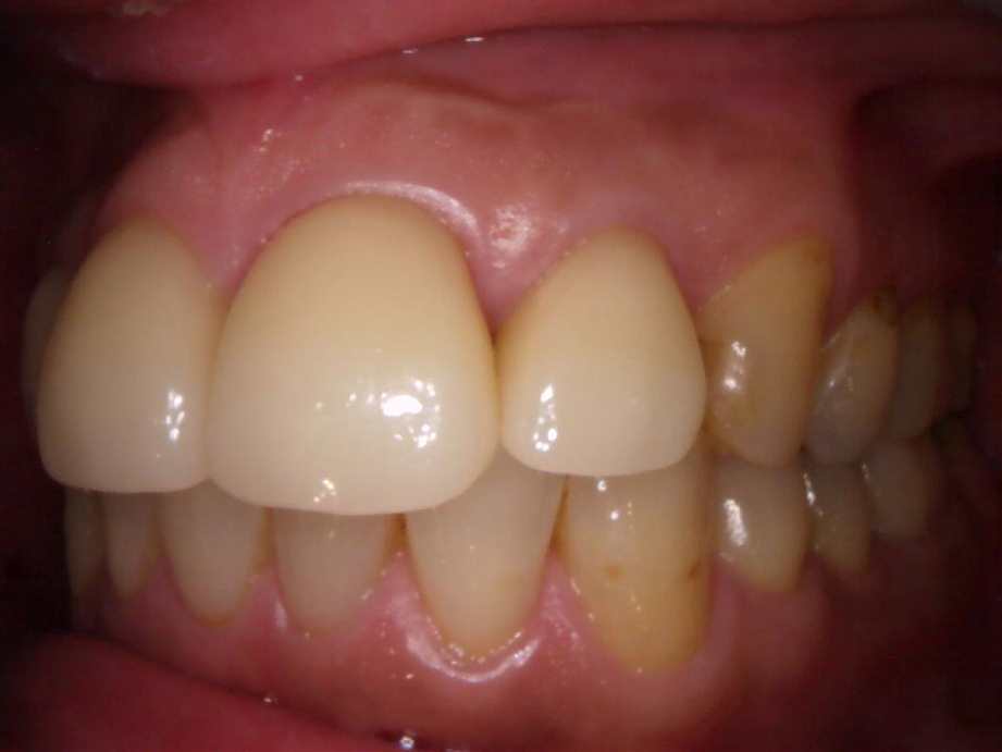 治療後（左側面）