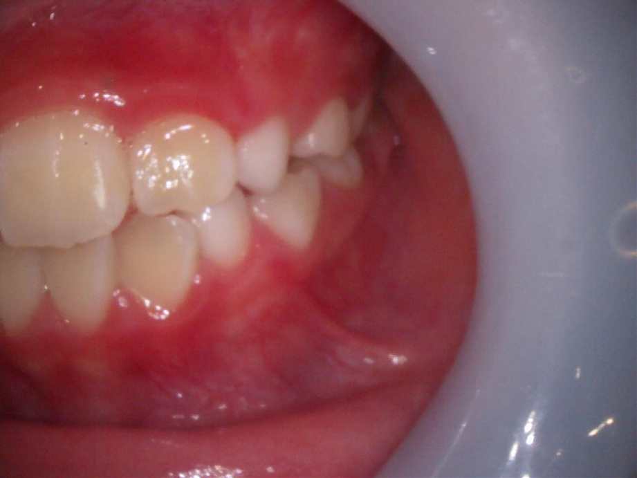 治療後（左側面）