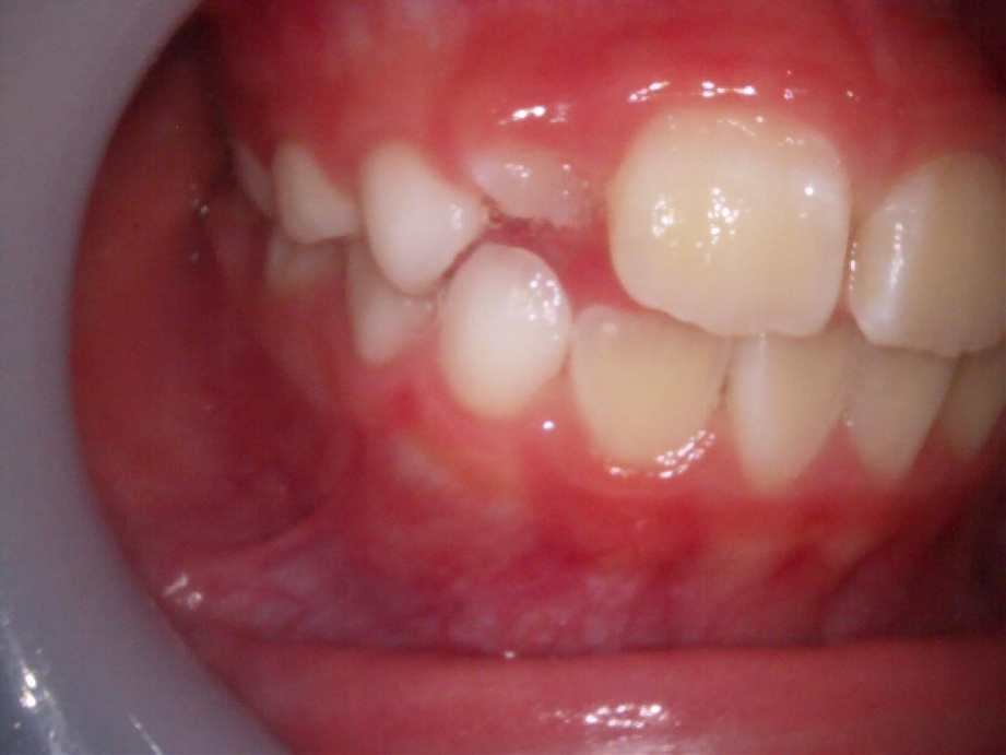 治療後（右側面）