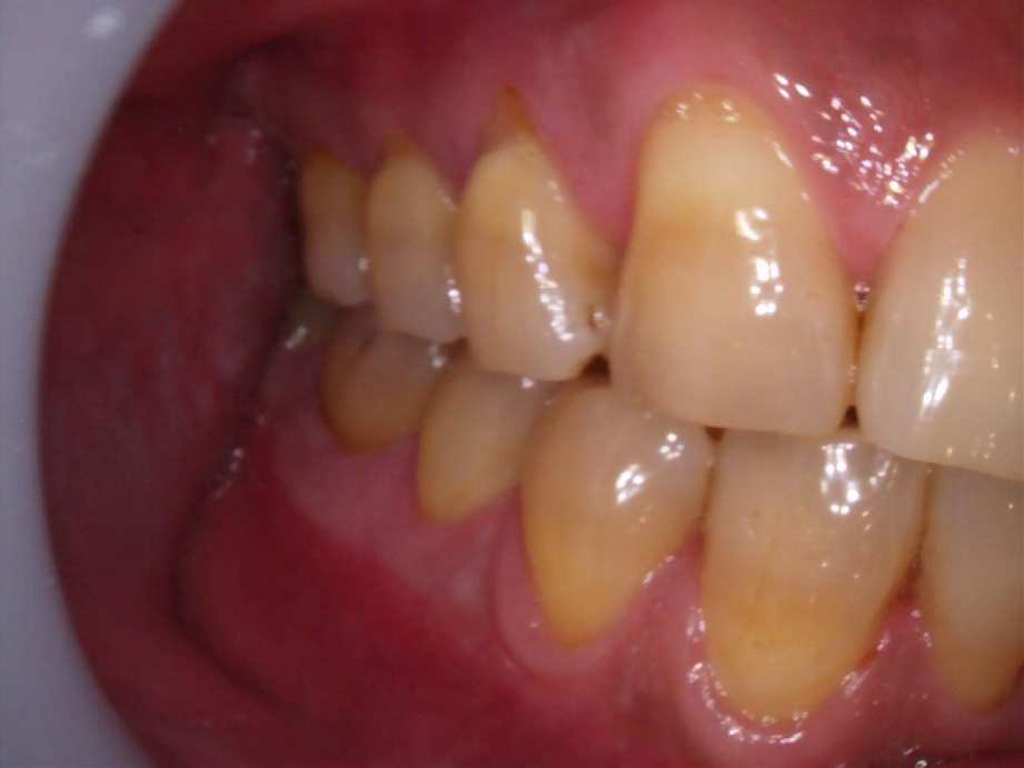 治療前（右側面）