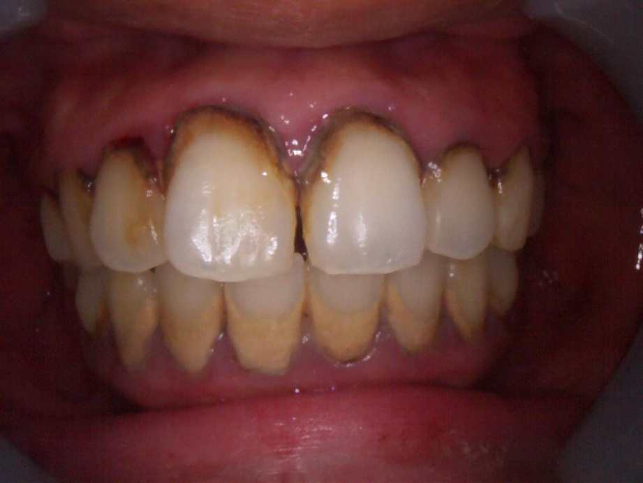 治療前（正面）