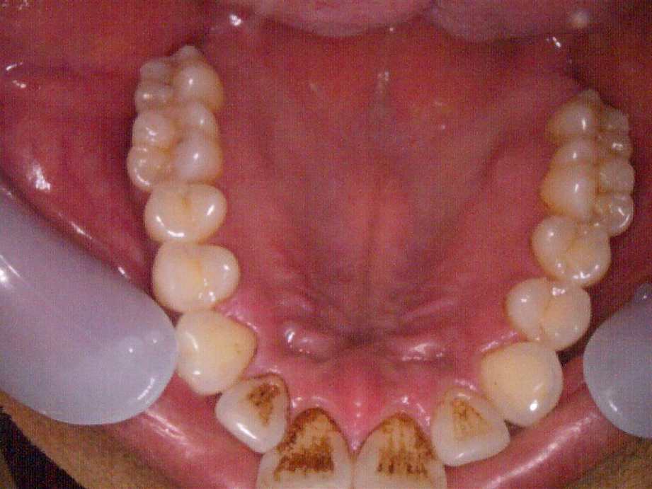 治療前（上顎）