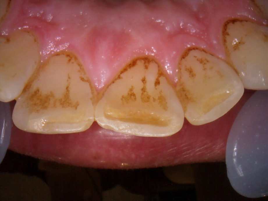 治療前（上顎）