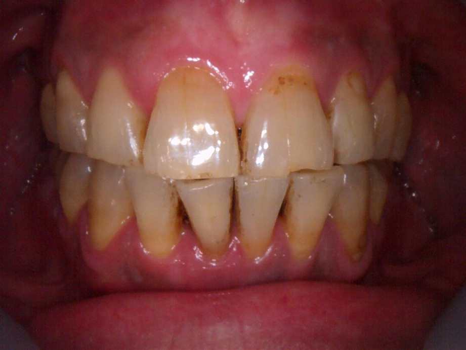 治療前（正面）