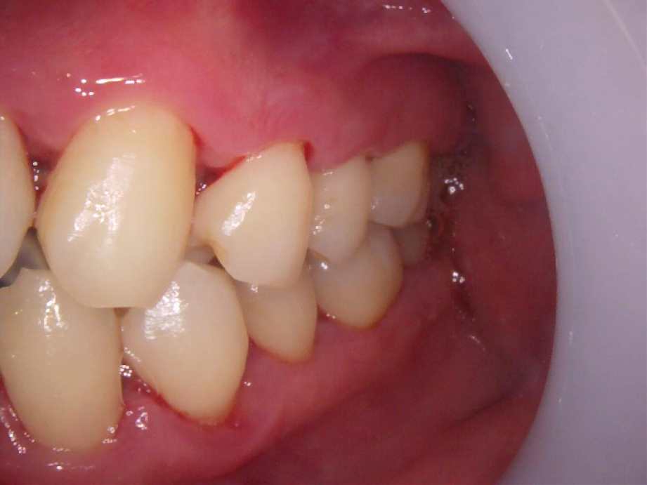 治療後（左側面）