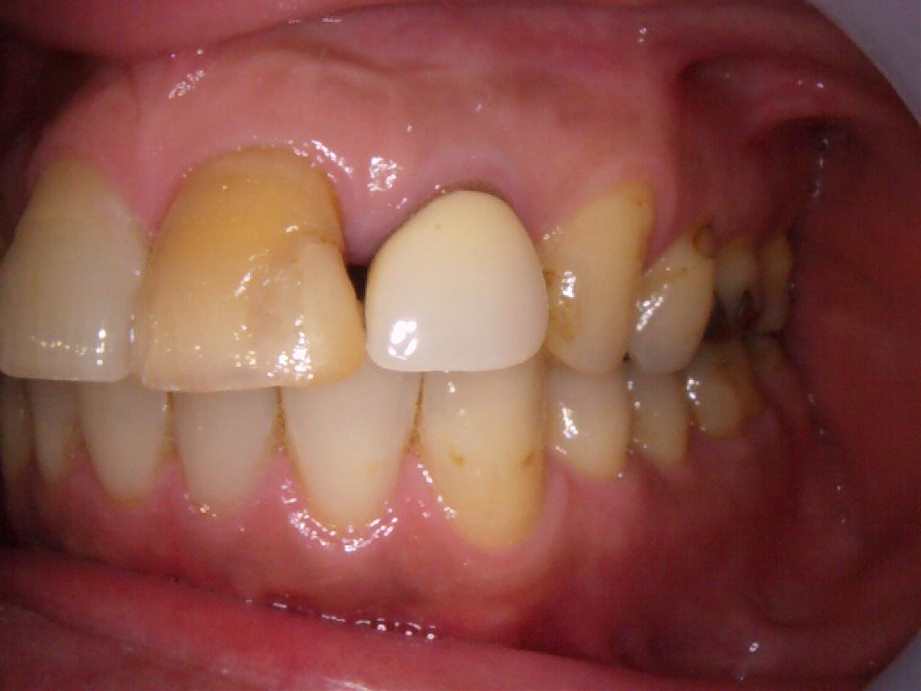 治療前（左側面）