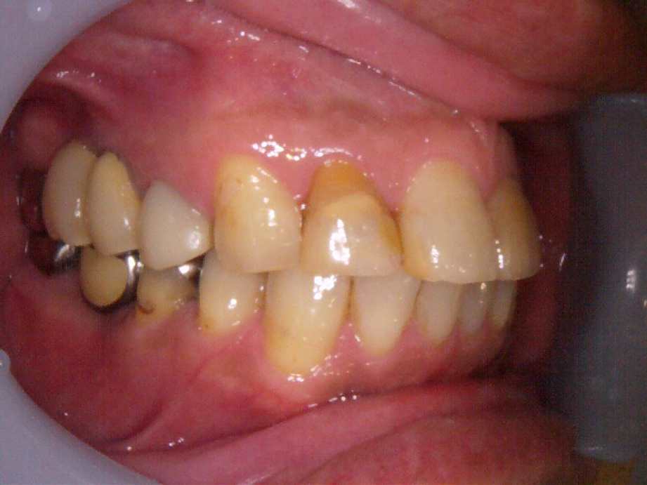 治療前（右側面）