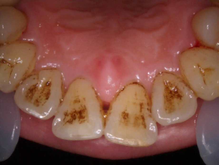 治療前（上顎）