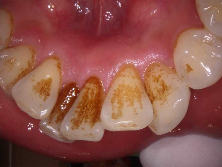 治療前（下顎アップ）