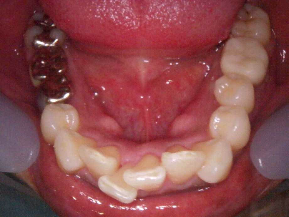 治療後（下顎）