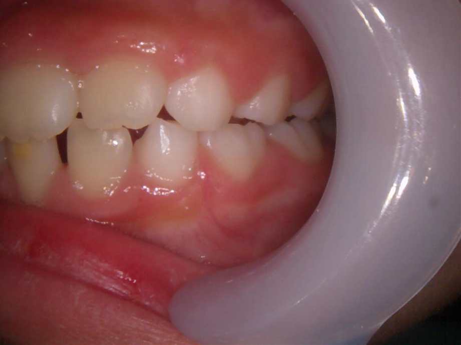 治療後（左側面）