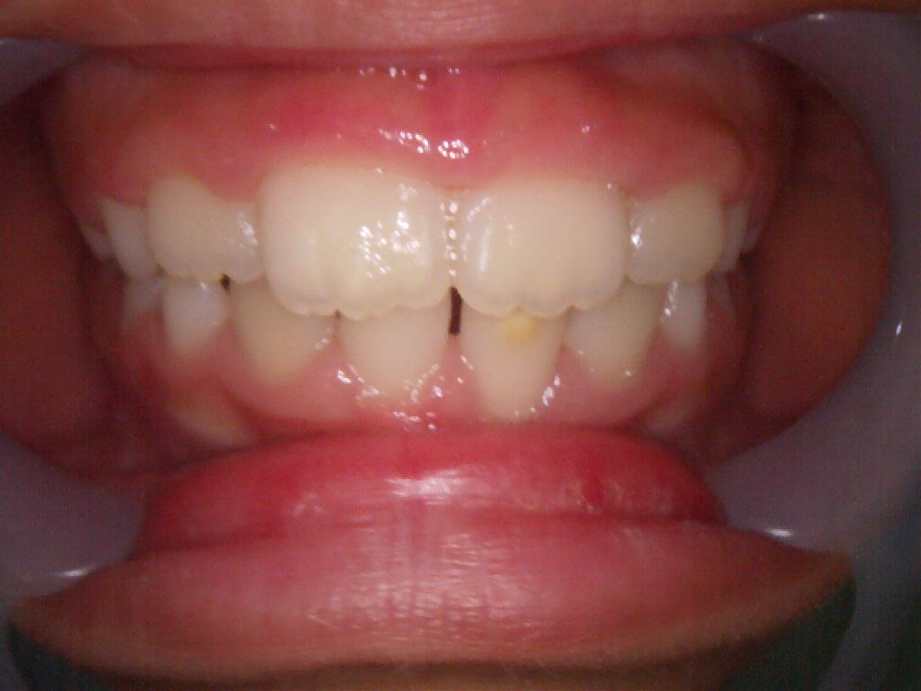 治療後（正面）