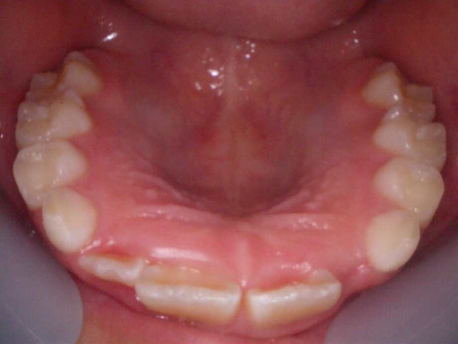 治療前（上顎）