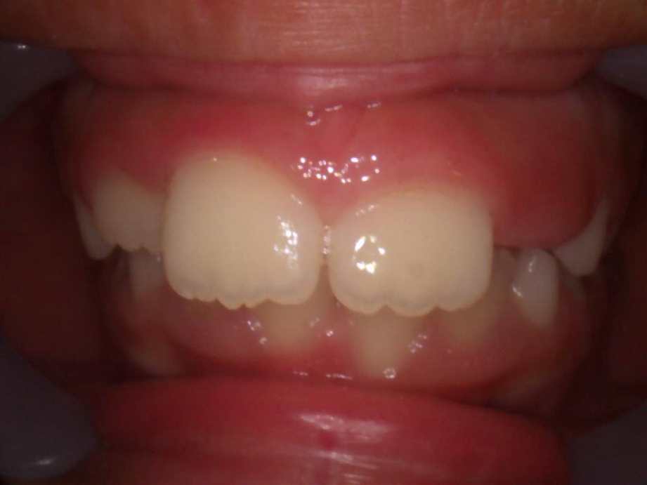 治療前（正面）