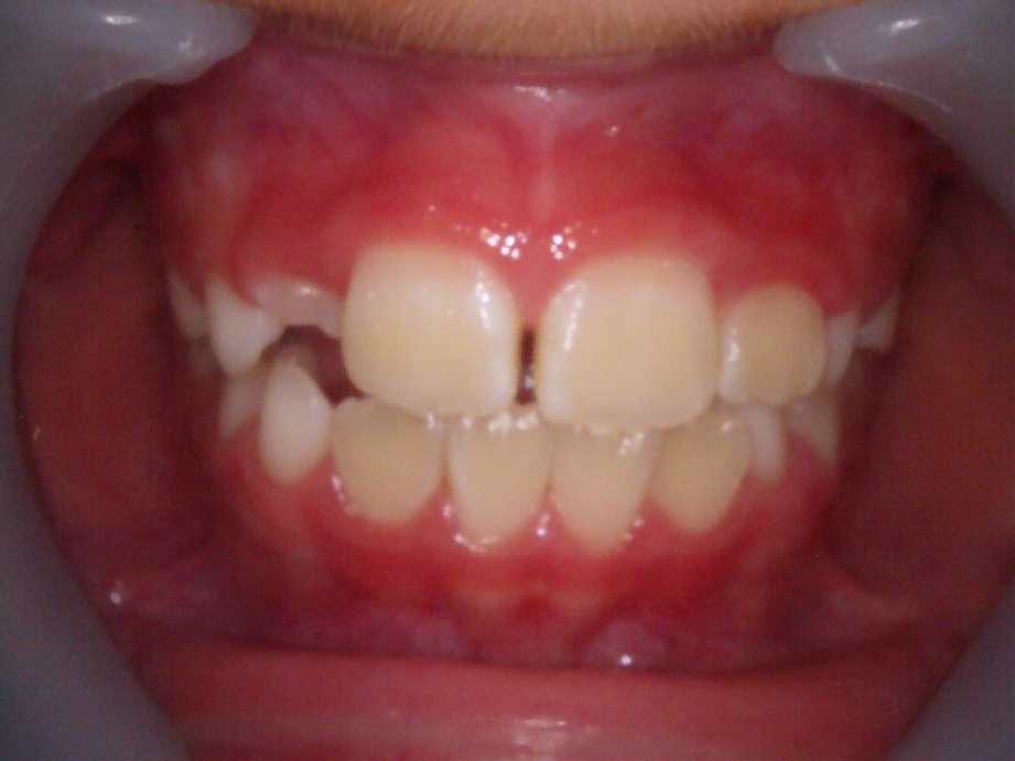 治療後（正面）