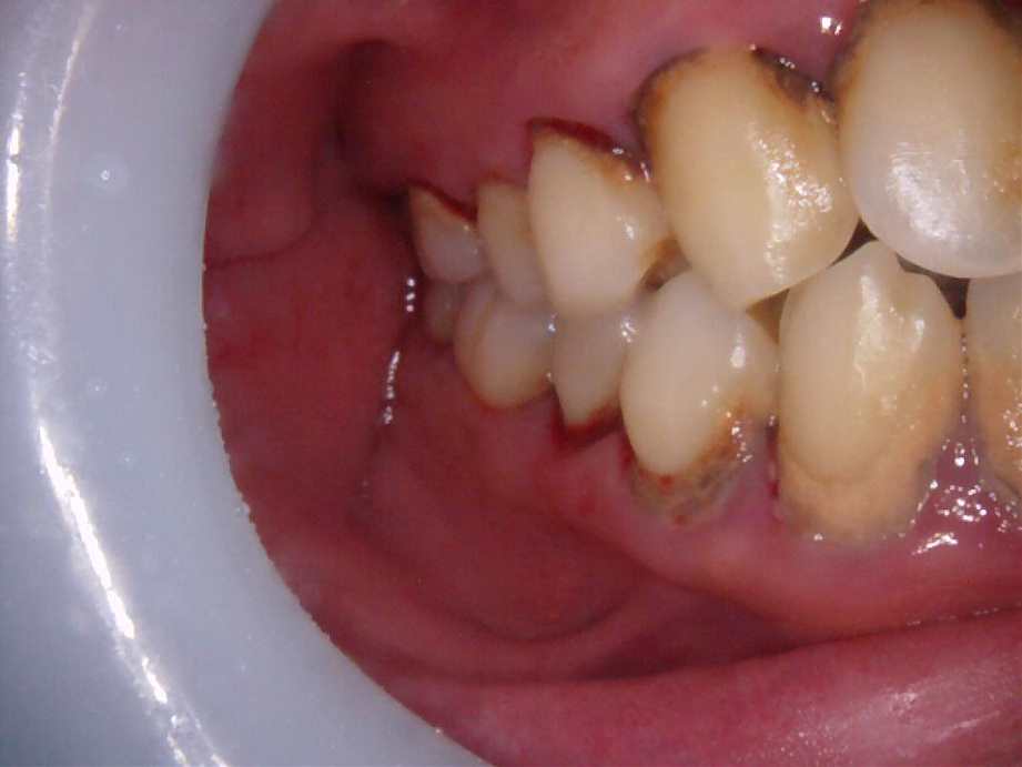 治療前（右側面）