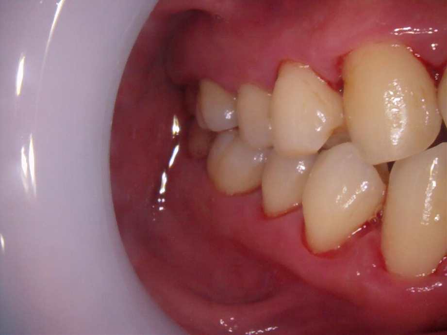 治療後（右側面）