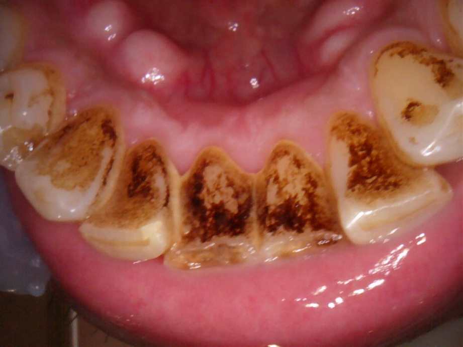 治療前（下顎）