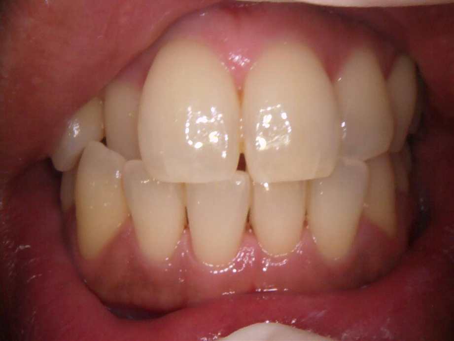 治療後（正面）