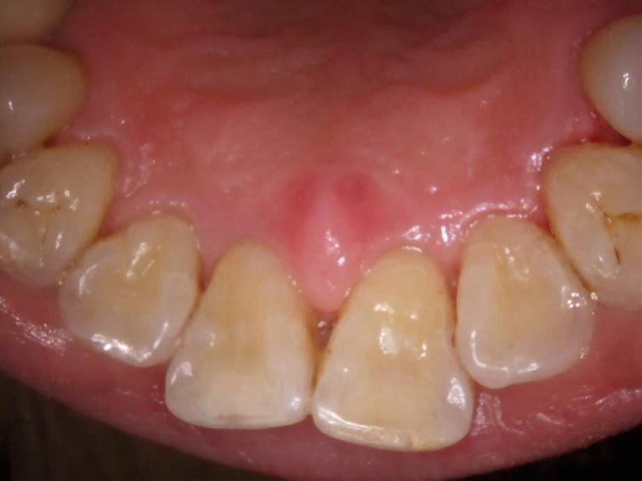 治療後（上顎）