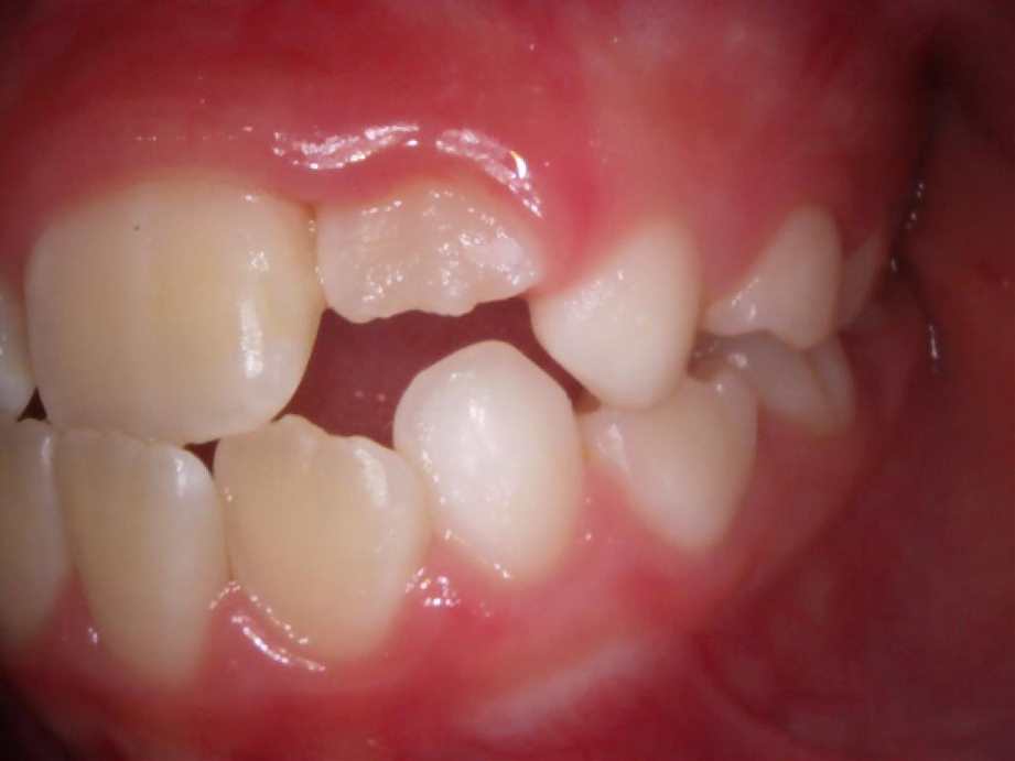 治療前（左側面）