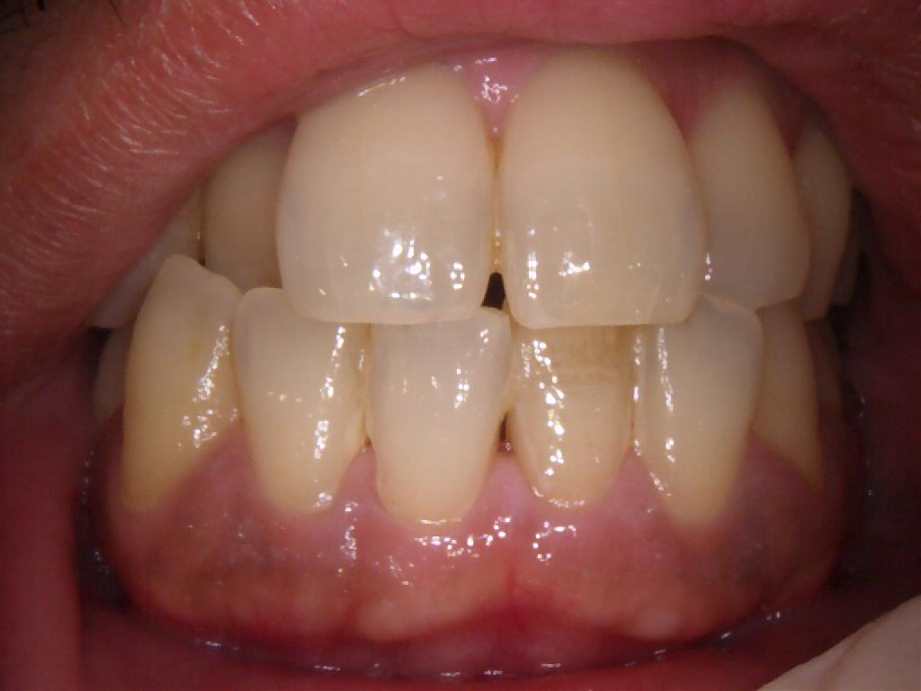 治療前（正面）