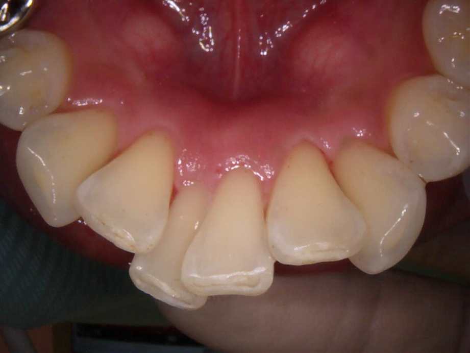 治療後（下顎アップ）