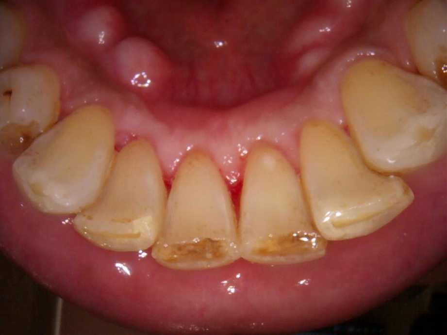 治療後（下顎）