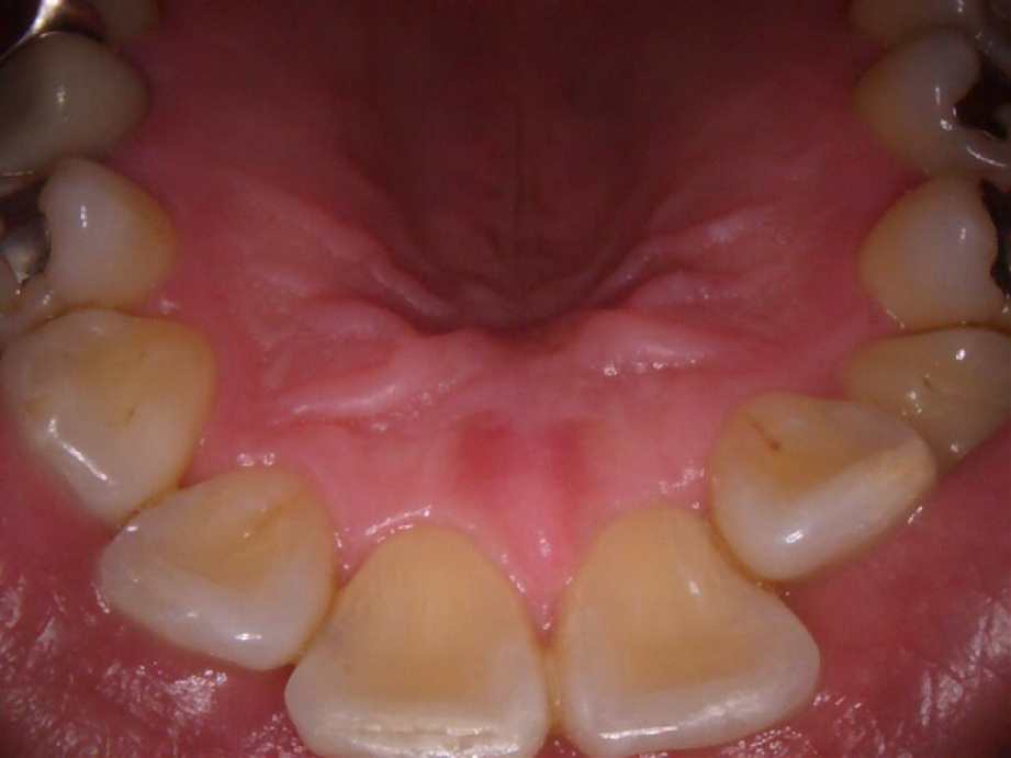 治療後（上顎）