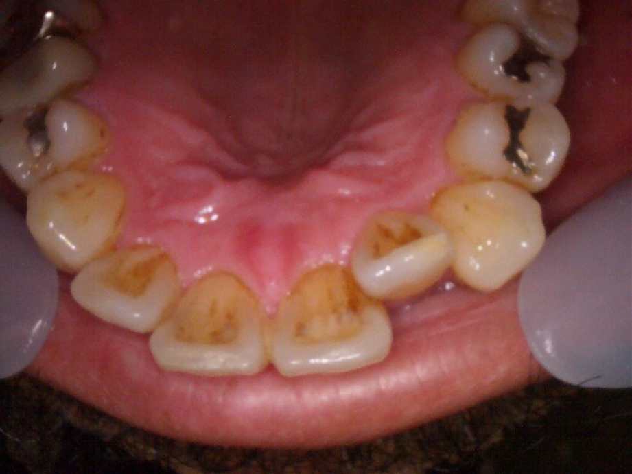 治療前（上顎）